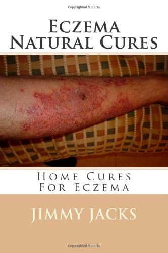 Eczema Natural Cures: Home Cures For Eczema